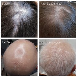 Certified Hair Growth Mesotherapist - Non-Invasive Mesotherapy (Theory and practice) with MESO PEN