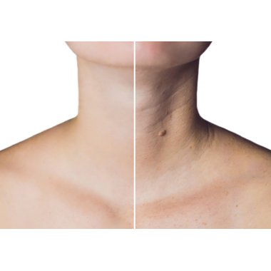 DÉCOLLÉTE AND NECK